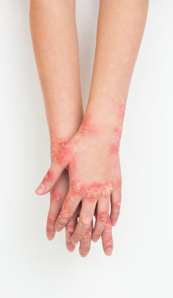 Hands showing signs of allergy, emphasizing the potential relief through allergy removal treatment